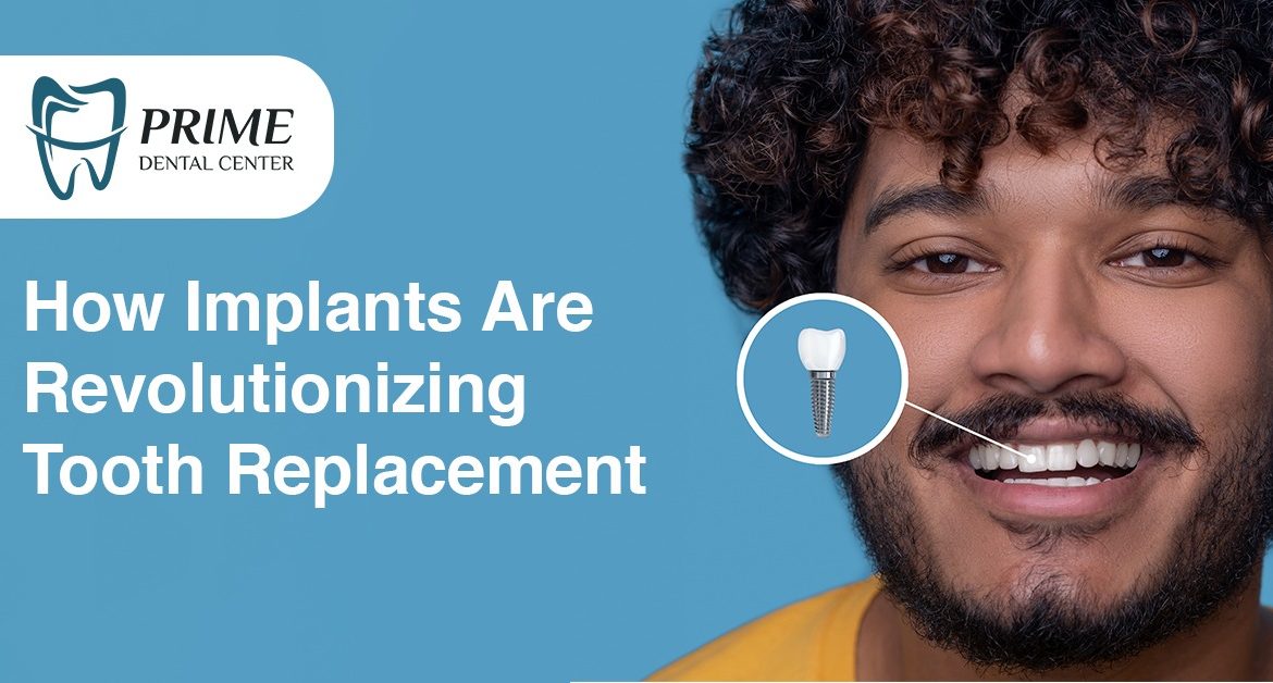 How Implants Are Revolutionizing Tooth Replacement