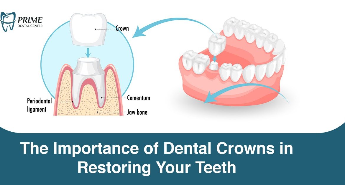The Importance of Dental Crowns in Restoring Your Teeth