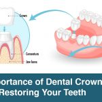 The Importance of Dental Crowns in Restoring Your Teeth
