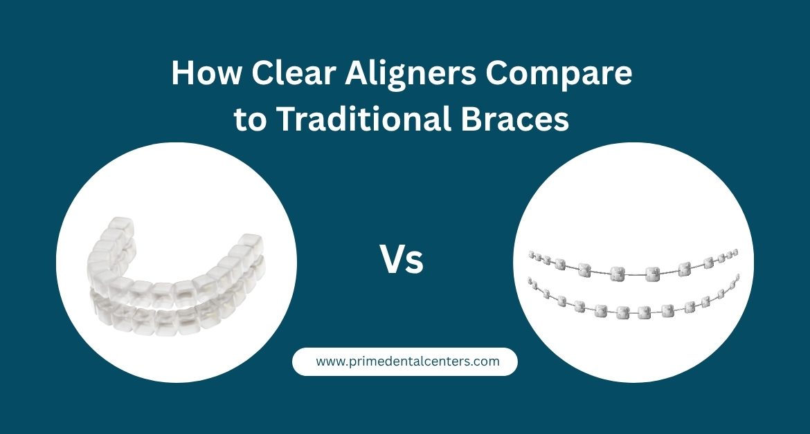 How Clear Aligners Compare to Traditional Braces
