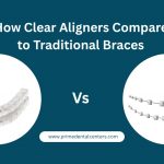 How Clear Aligners Compare to Traditional Braces