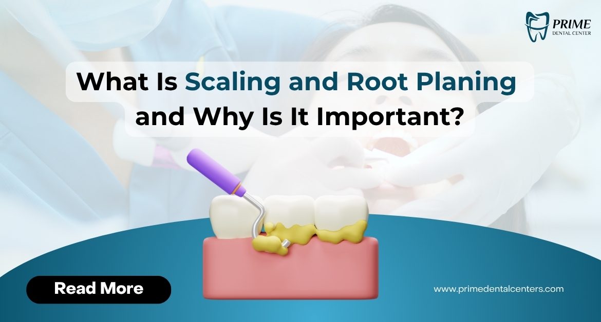 What Is Scaling and Root Planing and Why Is It Important