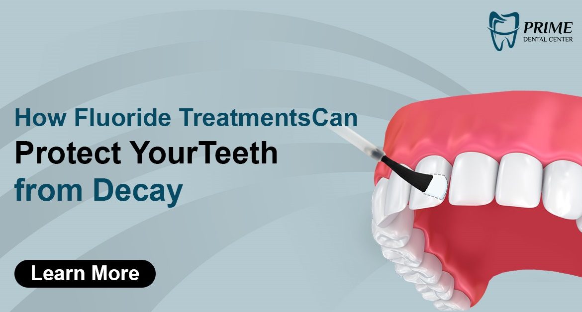 How Fluoride Treatments Can Protect Your Teeth from Decay