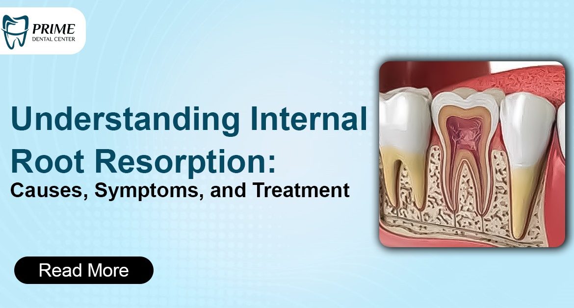 Understanding Internal Root Resorption: Causes, Symptoms, and Treatment