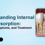 Understanding Internal Root Resorption: Causes, Symptoms, and Treatment